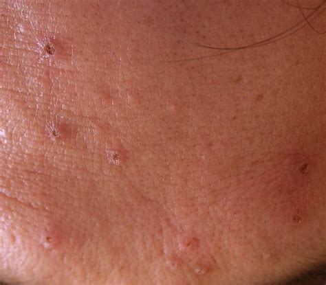 👉 Sebaceous Hyperplasia Pictures Removal Symptoms Treatment
