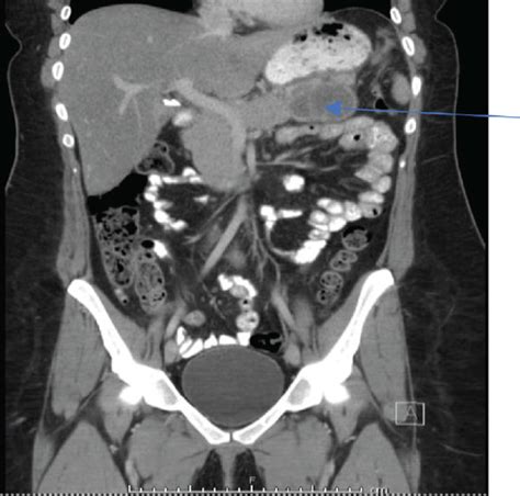 Ct Of The Abdomen And Pelvis With Oral And Iv Contrast Showing A Large