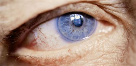 Mit zunehmendem alter nimmt die produktion von tränenflüssigkeit ab und die sehkraft des auges verringert sich. Glaukomdiagnostik - Augeninnendruck messen reicht nicht ...