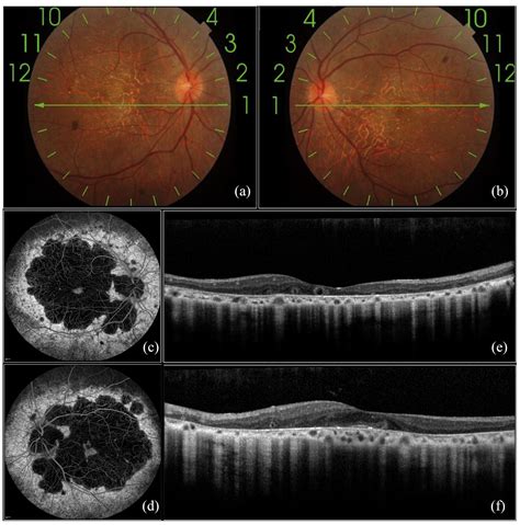 Role Of Red Free Imaging Retinal Reflectance And Fundus