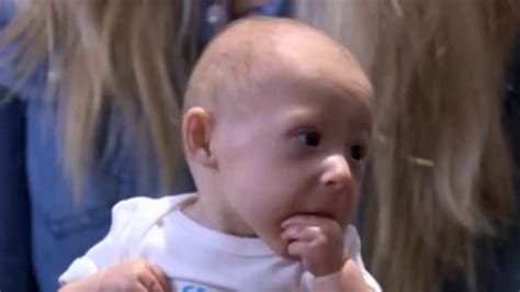 Matthew Kentucky Baby Born With Rare Form Of Dwarfism