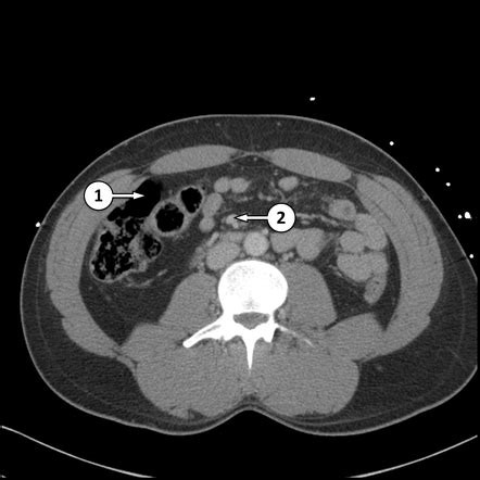 CT Abdomen Pelvis Lower Axial Labeling Questions Radiology Case