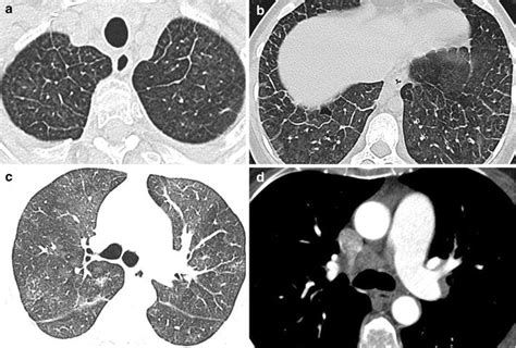 Pulmonary Veno Occlusive Disease The Role Of Ct Springerlink