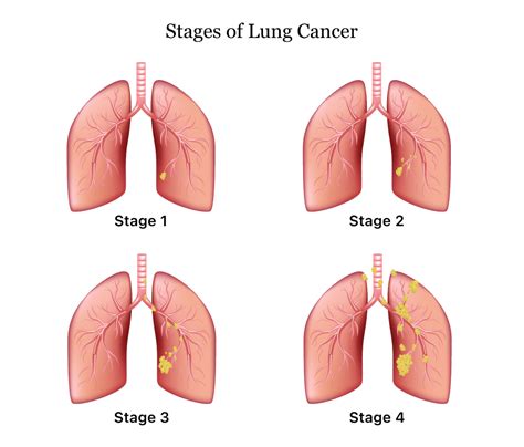 Genomic Cancer Profiling Setting A New Standard In Lung Cancer