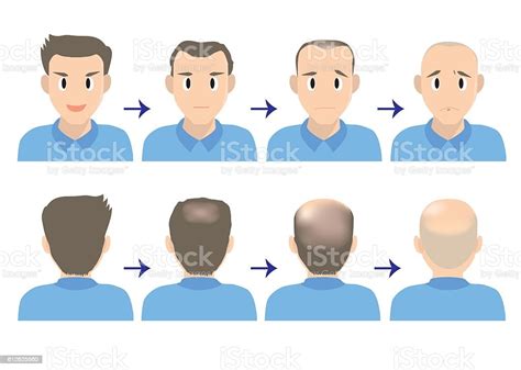 Balding Head B Stock Illustration Download Image Now Back Of Head