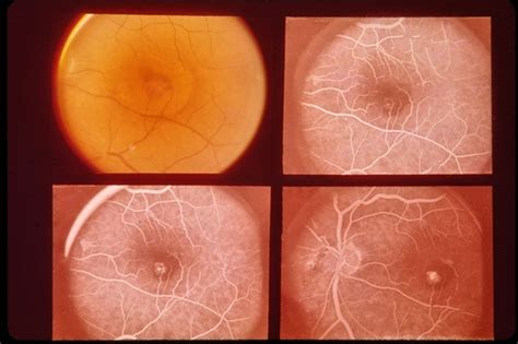 Central Serous Retinopathy Retina Image Bank