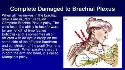 Ppt Of Lesions And Lessons The Brachial Plexus Powerpoint Presentation
