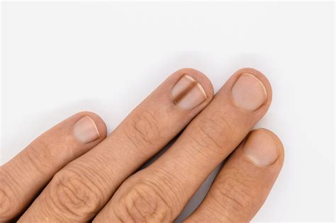 Black Lines On Nails Causes And Treatments Quick Telecast