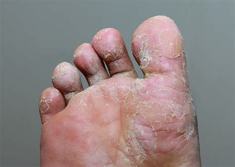 Athlete S Foot Tinea Pedis OC Foot And Ankle Clinic