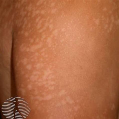 Best Treatments For Tinea Versicolor Skin Infection The Best Porn Website