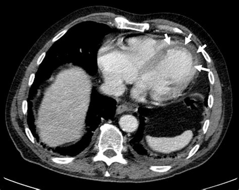 E Ct Scan Of The Heart Following Iodine Contrast Injection Transversal