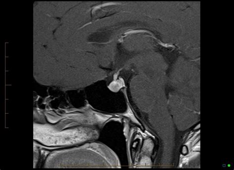 brain with contrast showing normal enhancement of the pituitary gland mri at melbourne