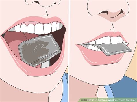 How To Reduce Wisdom Tooth Swelling 10 Steps With Pictures