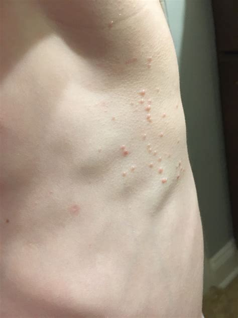 Molluscum Contagiosum Infection Bumps Rash On Skin Of Child Stock Photo