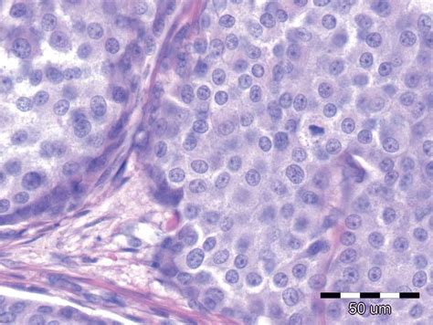 Primary Woman Neuroendocrine Breast Tumor Case Report And Review Of