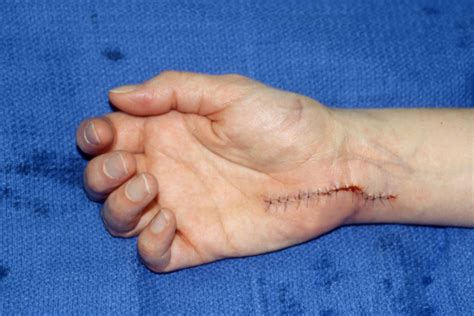 Ulnar Entrapment Guyons Hand Surgery Source