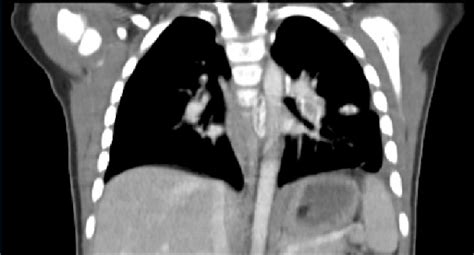Calcified Lymph Nodes With Left Lung Focus On Ct Chest Download