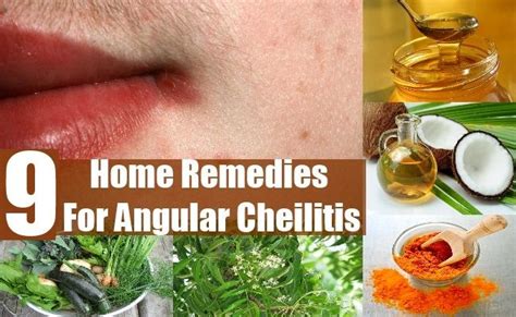Home Remedies For Angular Cheilitis Daily Health Tips Remedies Home