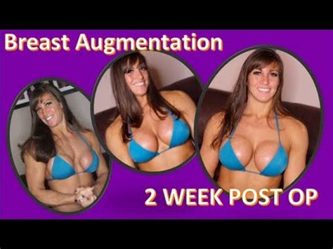 Weeks Post Breast Augmentation Youtube