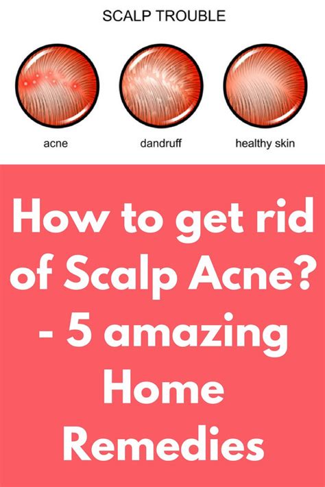 How To Get Rid Of Scalp Acne 5 Amazing Home Remedies Tired Of The