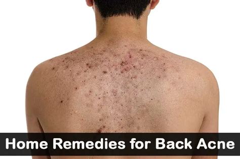 Home Remedies For Back Acne Wellnessguide
