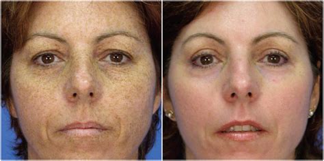 Microlaserpeel Tampa Elite Facial Plastic Surgery