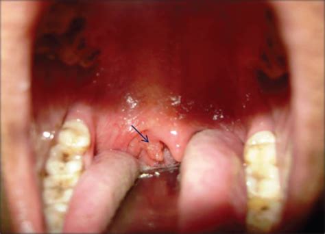 Cancer Bumps On Uvula