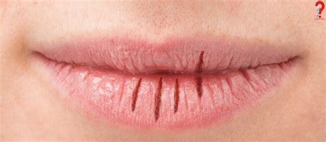 How To Reduce Swelling In Lip Causes And Treatment Howtowiki