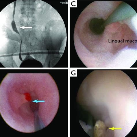 The Appearances Observed Under Ureteroscopy After Ureteral Download Scientific Diagram