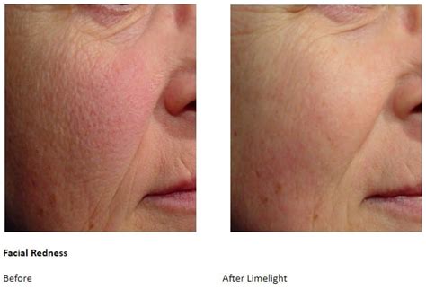 Limelight Laser Solihull Medical Cosmetic Clinic