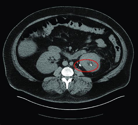 Computed Tomography Scan Of Abdomen And Pelvis With Intravenous