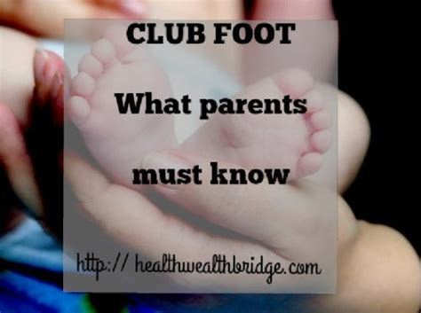 Club Foot What Parents Must Know Healthwealthbridge