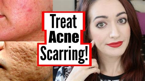 How To Treat Mild Moderate And Severe Acne Scarring Diy At Home