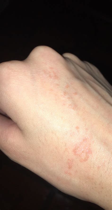 I Got This Rash Type Of Thing On My Hands And It Doesnt Want To Go