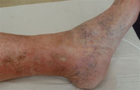 Leg Ulcers The Vein Clinic