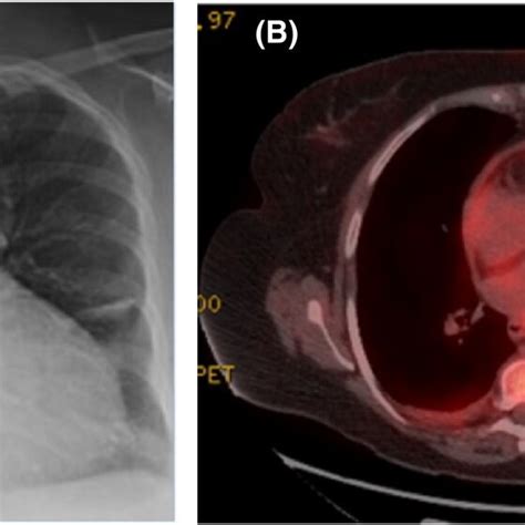 A Chest X‐ray Showing Cardiomegaly B Moderate Uptake In The Pleura