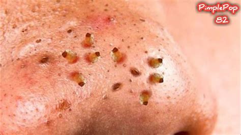 Satisfying Videos Pimples Popping Blackheads Acne And Cysts