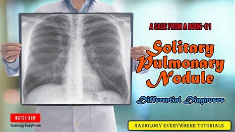 Solitary Pulmonary Nodule Radiology Differential Diagnoses Youtube