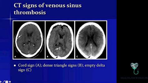 Imaging Features Of Venous Sinus Thrombosis Part 2