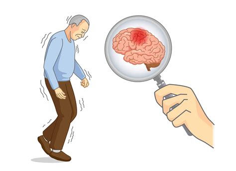 Patients Ask What Can Mimic Parkinsons Disease Altoida