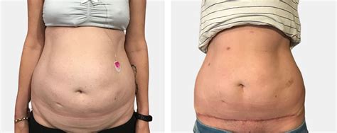 Mini Tummy Tuck Before And After Bb Clinic Sydney