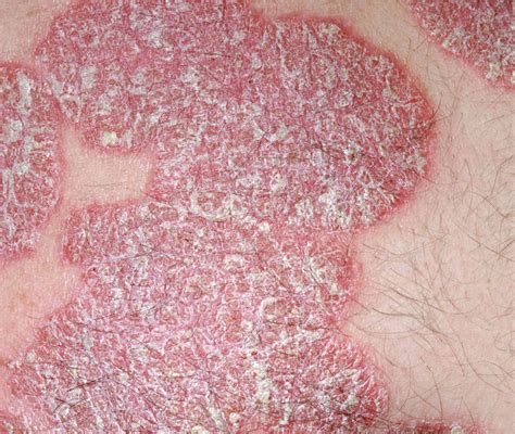 Diagnosis And Management Of Mild To Moderate Psoriasis Le Roux 2020