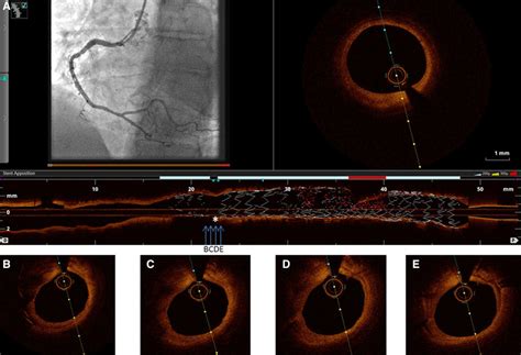 Restenosis Of Drug Eluting Stents Circulation Cardiovascular