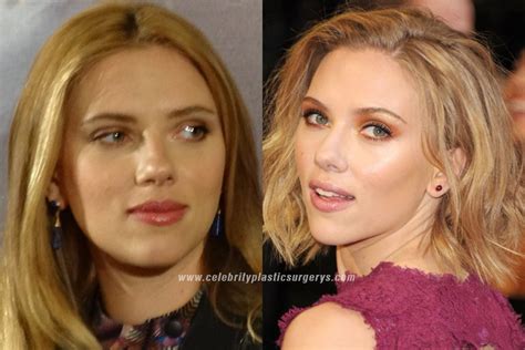 Scarlett Johansson Plastic Surgery Before And After With Pics
