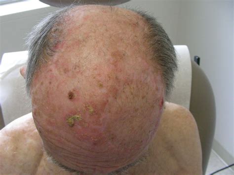 Health From Trusted Sources Actinic Keratoses