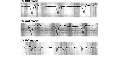 Pacemaker Rhythm At Different Stimulation Modes A Both Pacing Spikes