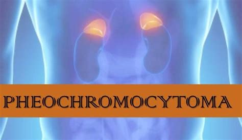 Pheochromocytoma Causes Picture Symptoms And Treatment