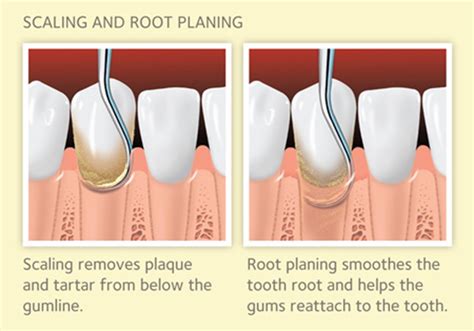 Scaling And Root Planing For Gum Disease Mouthhealthy Oral Health