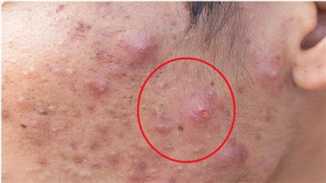 How To Get Rid Of Fungal Acne At Home Youtube