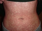 Morbilliform Rash Ebv